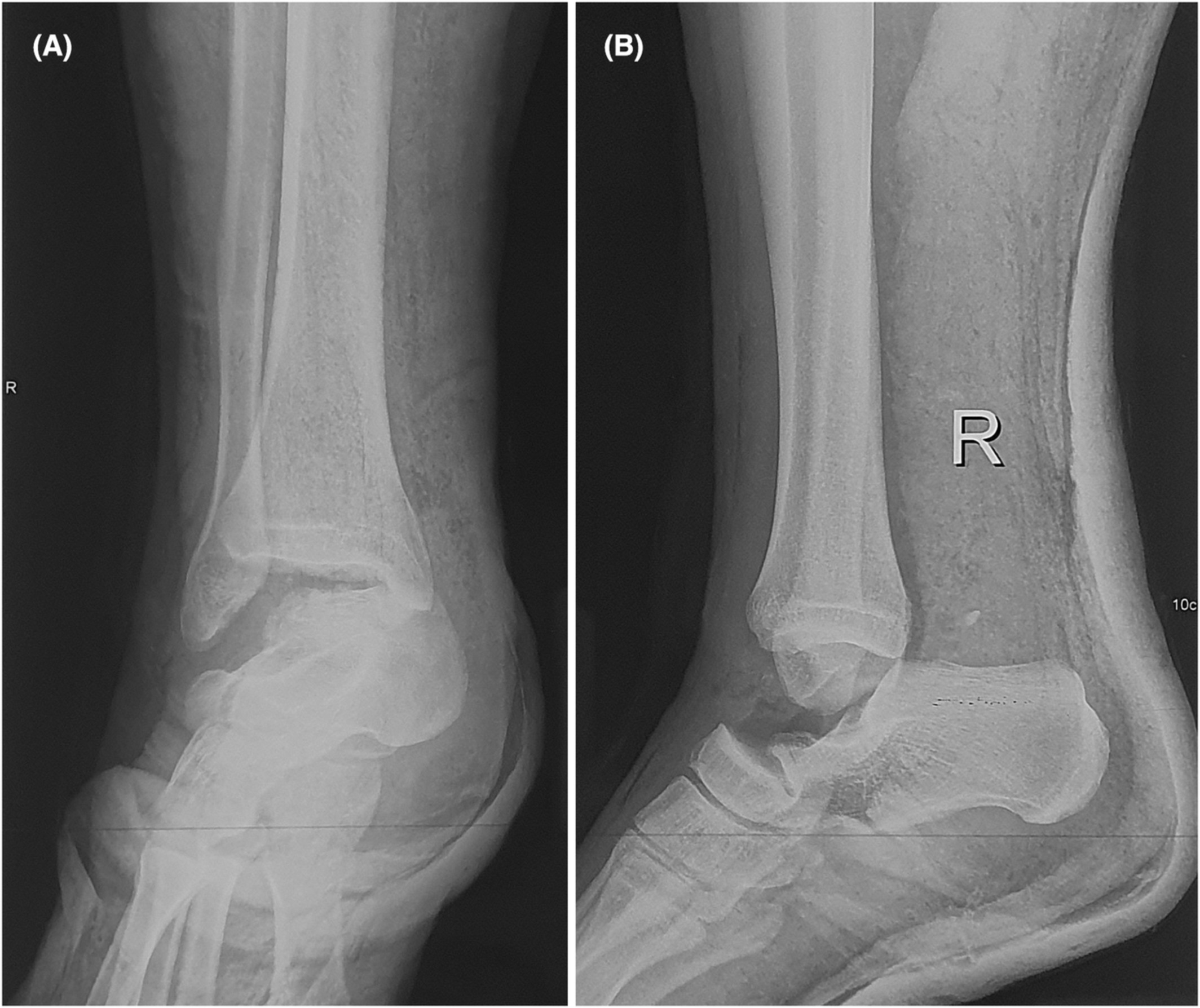 Post-traumatic missing talus: Staged allograft interposition and fusion. Should we fuse the “talo-navicular” joint?