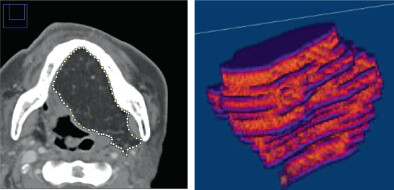 Free-flap volume correlates with body mass index in patients with tongue squamous cell carcinoma