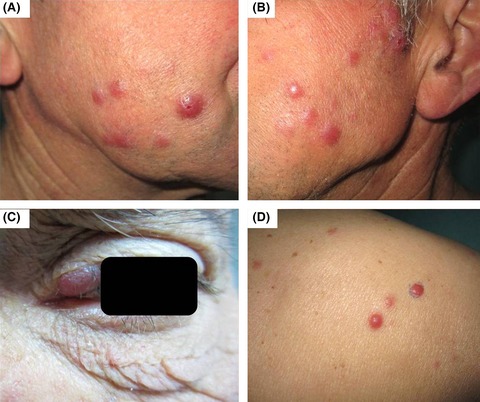 Multiple primary cutaneous plasmacytoma a decade after a nasal solitary extramedullary plasmacytoma: a puzzling case