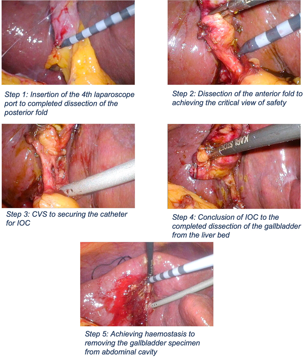 3D visualization systems improve operator efficiency during difficult laparoscopic cholecystectomy: a retrospective blinded review of surgical videos