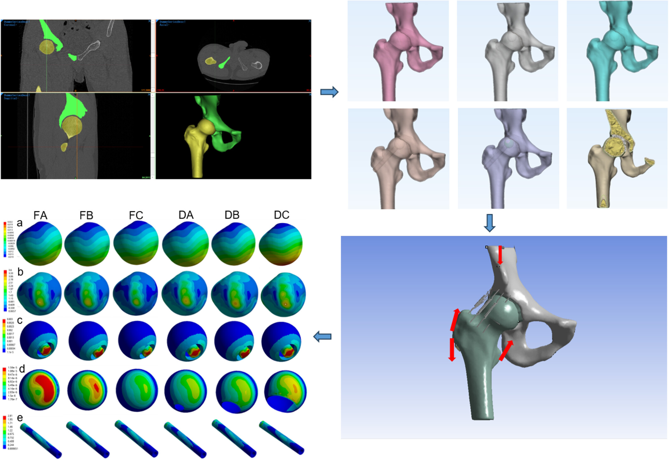 Effect of Sclerosis Bands in Femoral Head Necrosis on Non-Vascularized Fibular Grafting—A Finite Element Study