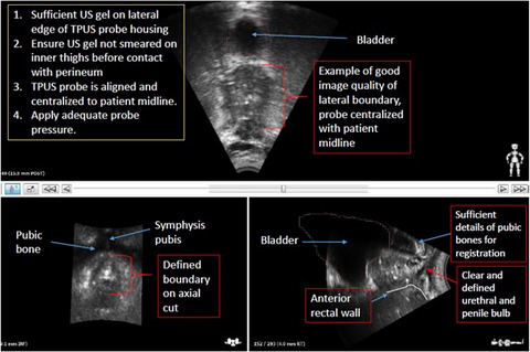 Technical considerations for positioning and placement of a transperineal ultrasound probe during prostate radiotherapy