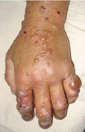 Skin lesions and neutrophilic leukemoid reaction in a patient with angioimmunoblastic T-cell lymphoma: a case report and review of the literature