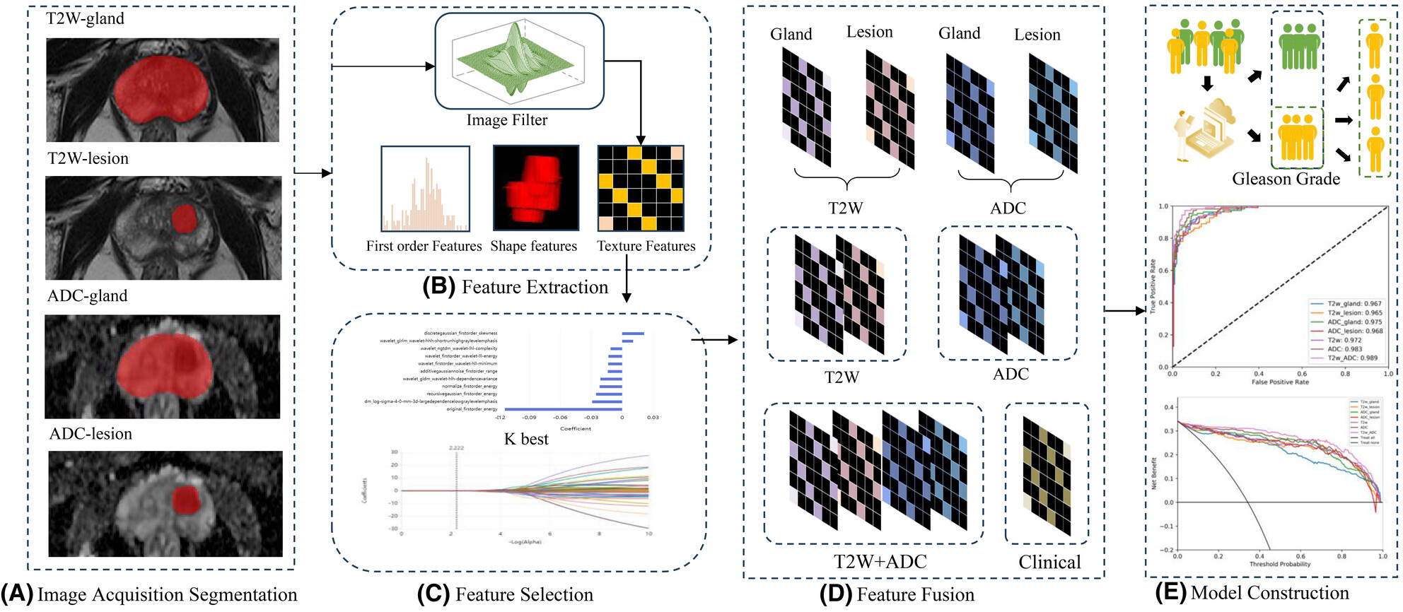 A two-stage model for precise identification and Gleason grading of clinically significant prostate cancer: a hybrid approach