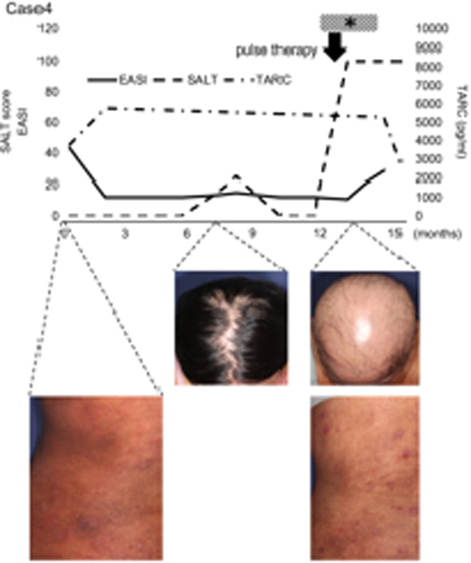 Two-sided influence of dupilumab on alopecia areata co-existing with severe atopic dermatitis: A case series and literature review