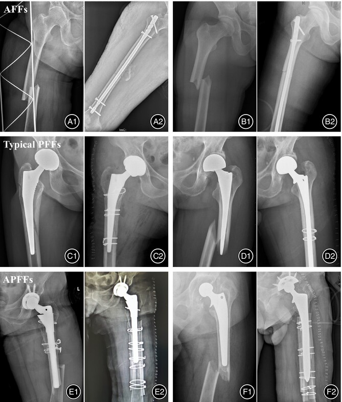 Atypical Periprosthetic Femoral Fracture Might be Considered a Distinct Subtype of Atypical Femoral Fracture: A Retrospective Study