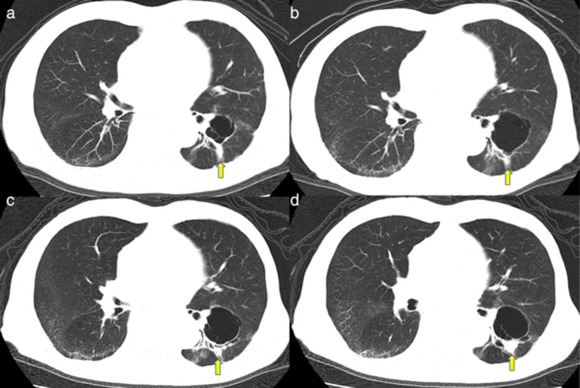 Long-term response to afatinib in an elderly patient with uncommon epidermal growth factor receptor mutation-positive lung adenocarcinoma
