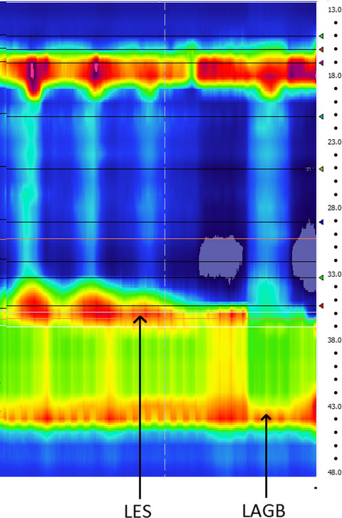 Reversible Jackhammer esophagus in a patient with a gastric band