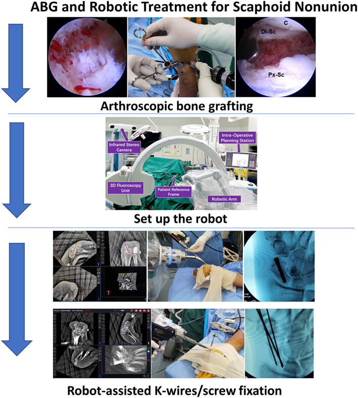 Arthroscopic Bone Grafting and Robot-assisted Fixation for Scaphoid Nonunion