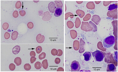 Acute hemolytic anemia after hematopoietic stem cell transplantation: An unusual invader