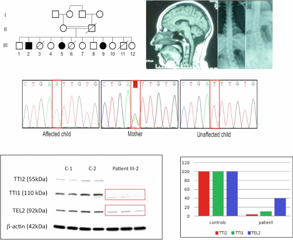 Mutation in TTI2 Reveals a Role for Triple T Complex in Human Brain Development