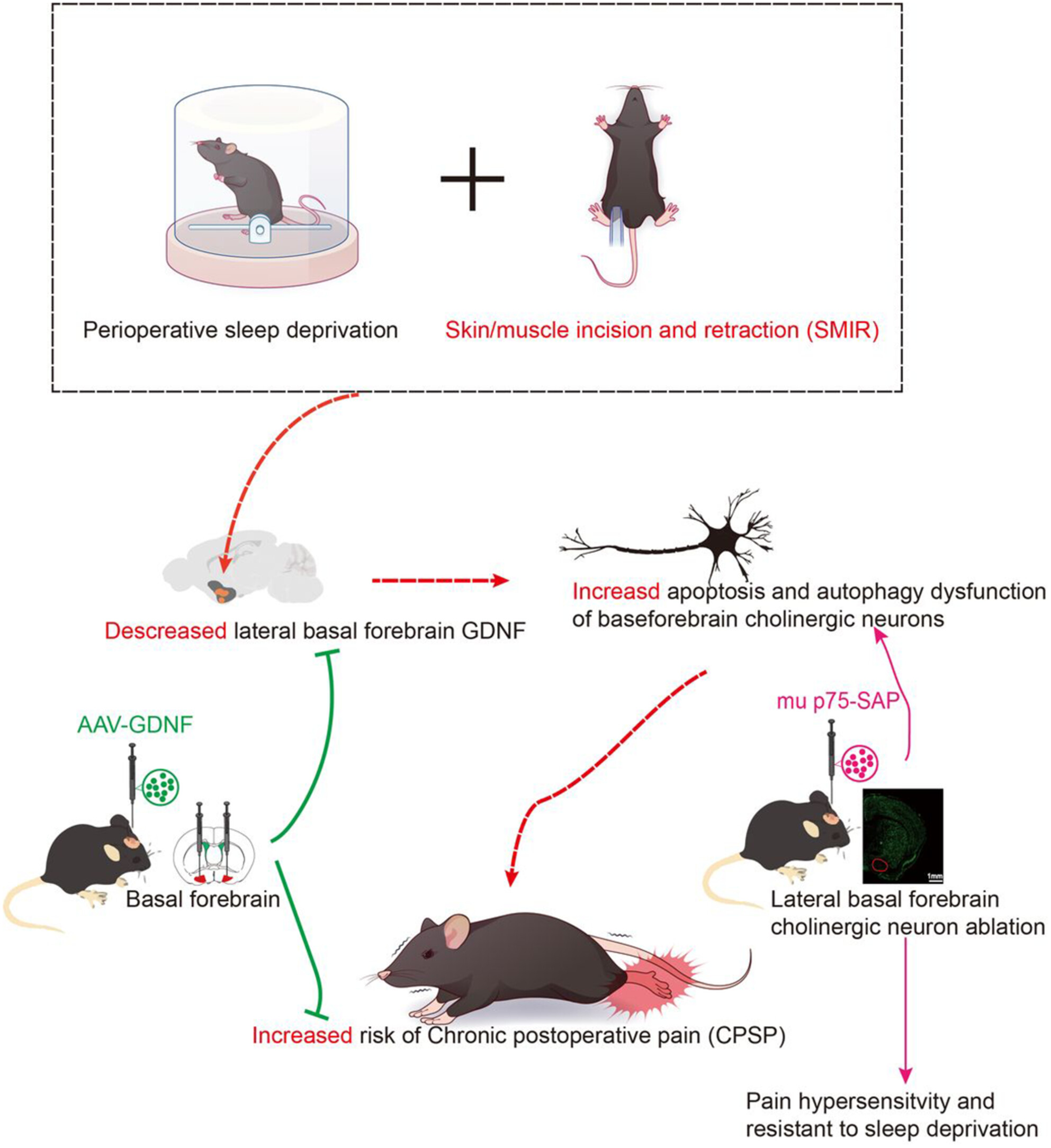 Impaired Basal Forebrain Cholinergic Neuron GDNF Signaling Contributes to Perioperative Sleep Deprivation–Induced Chronicity of Postsurgical Pain in Mice Through Regulating Cholinergic Neuronal Activity, Apoptosis, and Autophagy