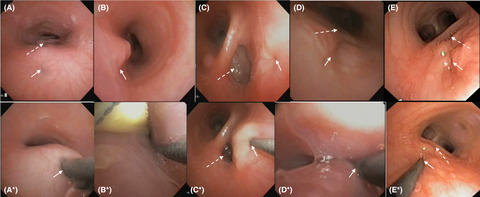 Flexible bronchoscopy in diagnosis and management of dual tracheoesophageal fistula: A case series
