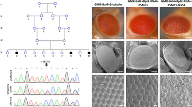 PSMC1 variant causes a novel neurological syndrome