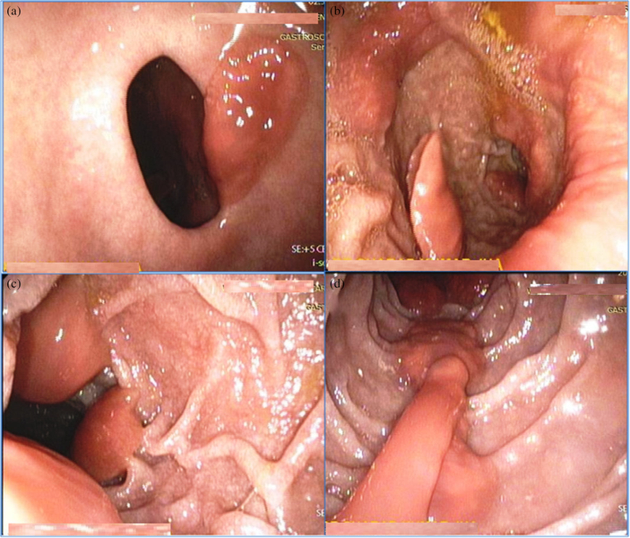 Endoscopic diagnosis of Fasciolopsis buski: Revisited (with video)
