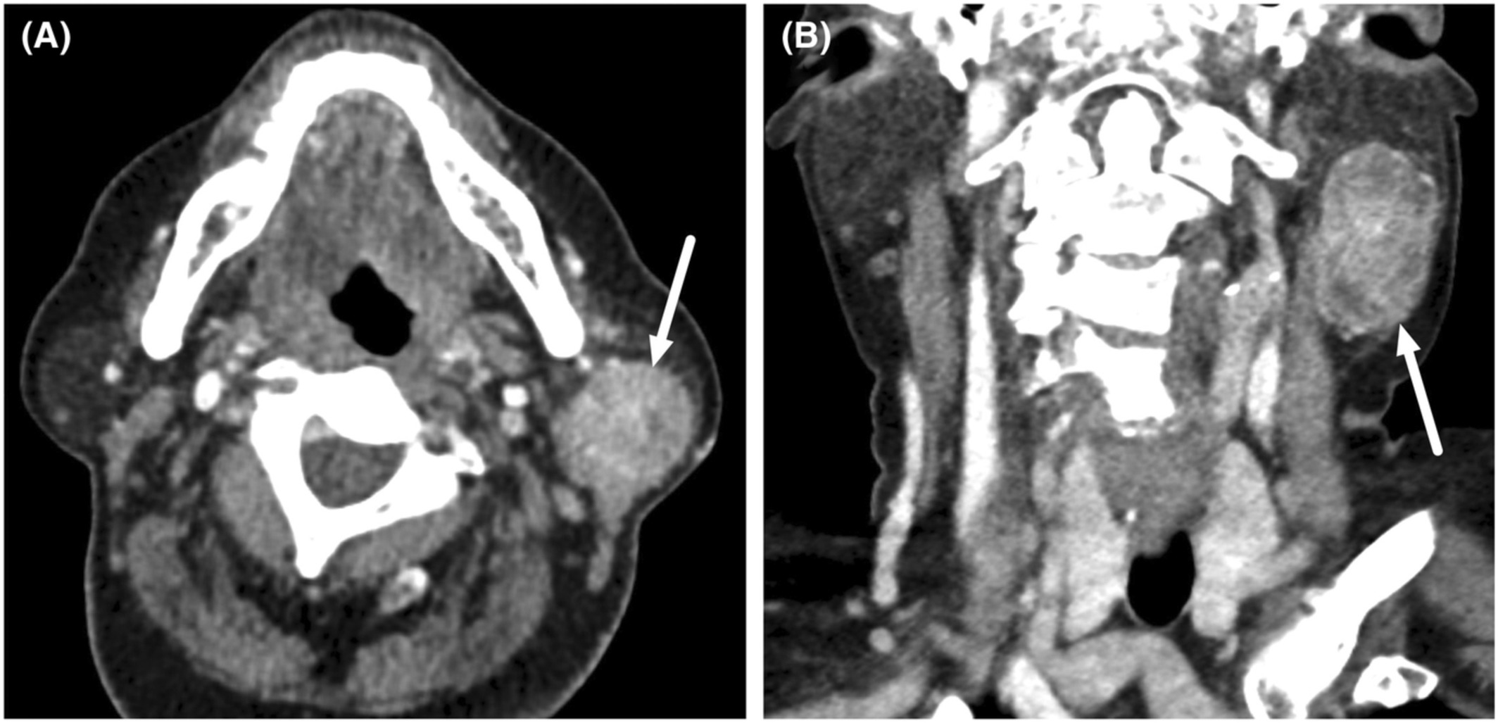Tumor-to-tumor metastasis to Warthin tumor presenting as an initial sign of breast carcinoma: A case report
