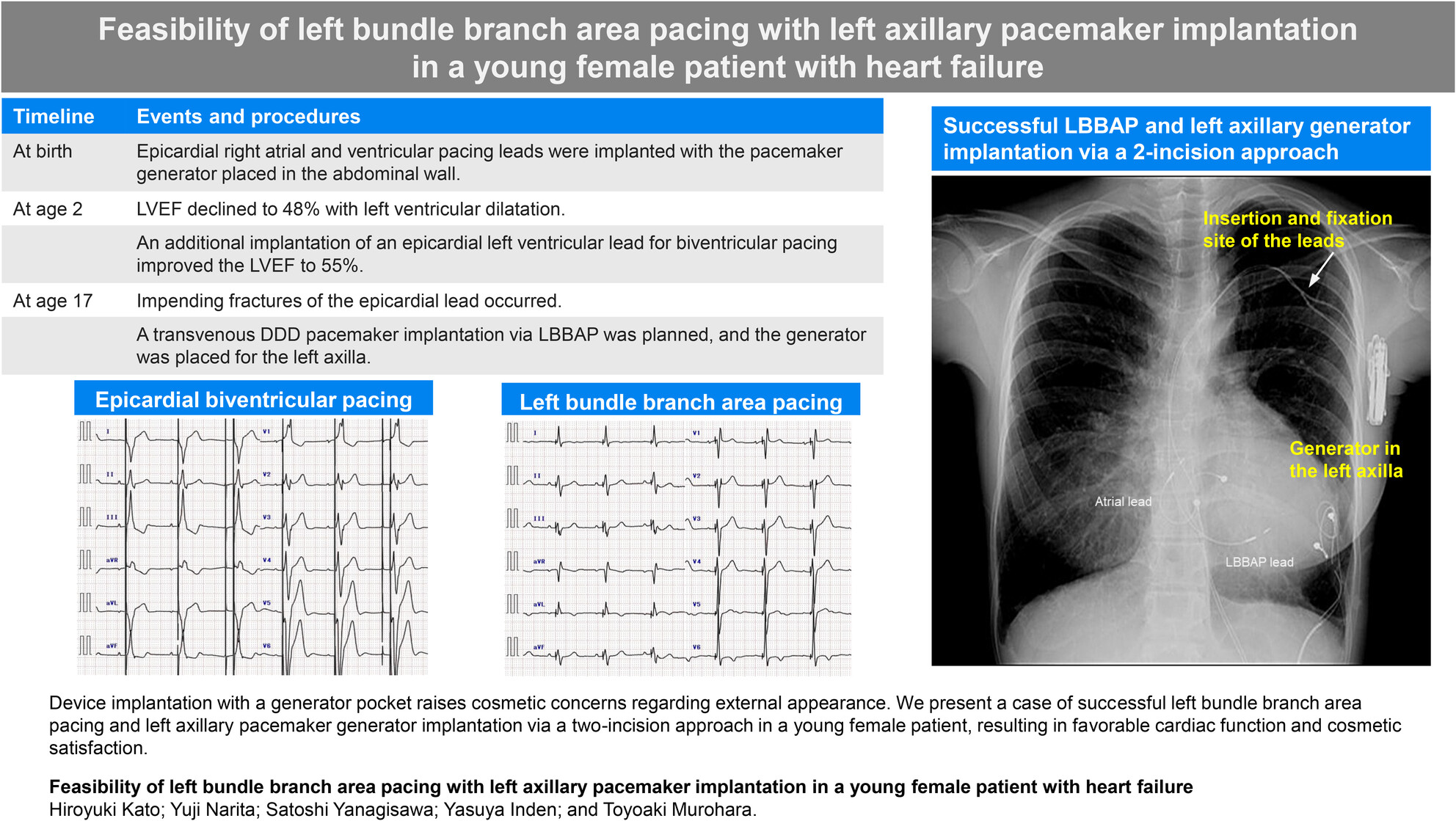 Feasibility of left bundle branch area pacing with left axillary pacemaker implantation in a young female patient with heart failure