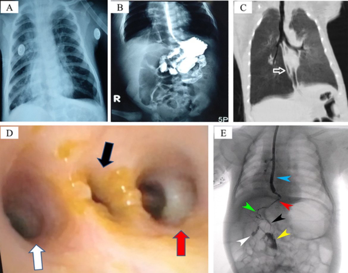 Congenital bronchobiliary fistula: a case report and literature review