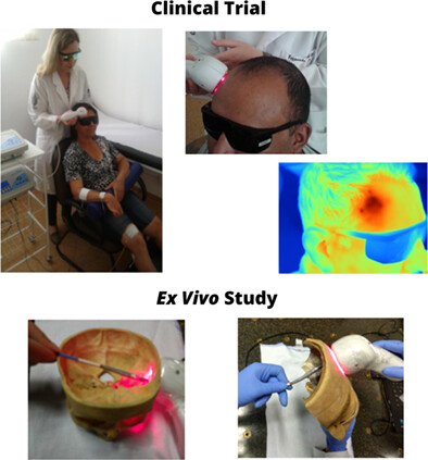 The effects of transcranial laser photobiomodulation and neuromuscular electrical stimulation in the treatment of post-stroke dysfunctions