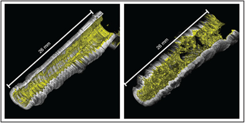 Quantitative assessment of airway remodelling and response to allergen in asthma