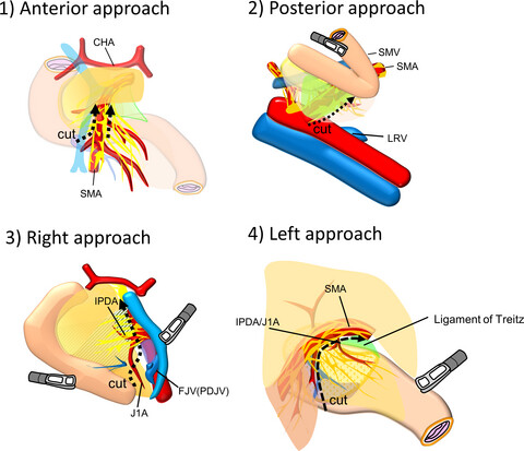 Surgical approaches to the superior mesenteric artery during minimally invasive pancreaticoduodenectomy: A systematic review