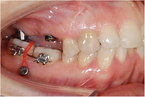 Intrusion of overerupted molars with temporary anchorage devices before prosthetic reconstruction: A case report