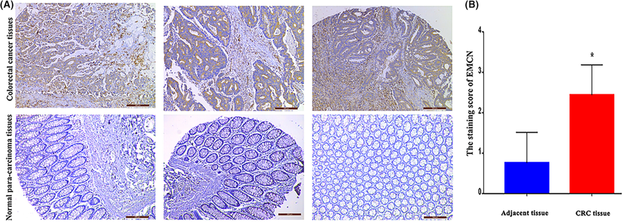 Tumor-derived endomucin promotes colorectal cancer proliferation and metastasis