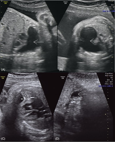 Prenatal ultrasonic features of a mediastinal teratoma: A case report and literature review