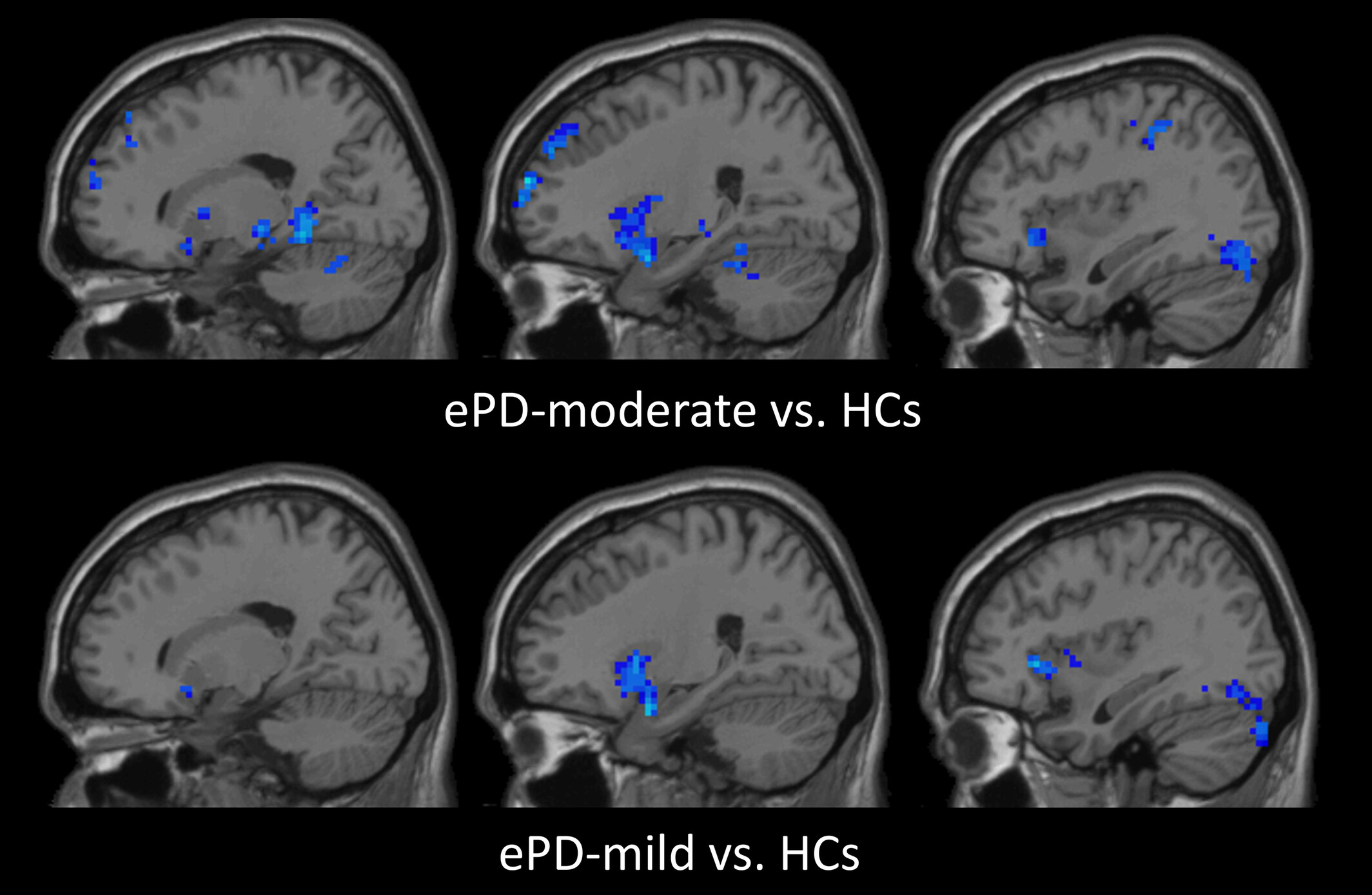 Exploring brain asymmetry in early-stage Parkinson's disease through functional and structural MRI
