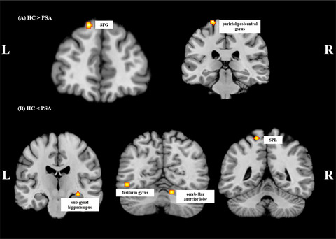 The changed functional status of the brain was involved in patients with poststroke aphasia: Coordinate-based (activation likelihood estimation) meta-analysis