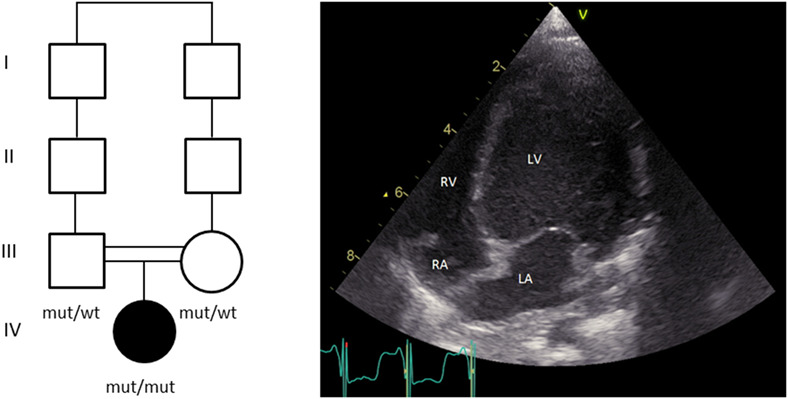 Expanding the clinical spectrum of primary coenzyme Q10 deficiency type 6: The first case with cardiomyopathy