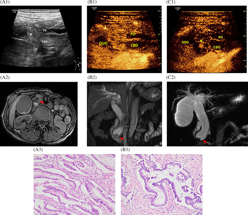 Differential diagnostic value of periampullary mass: A nomogram established by random forest based on clinical characteristics and contrast-enhanced ultrasound