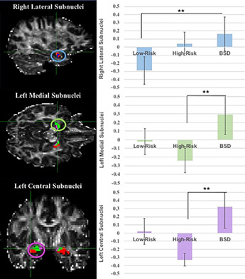 Amygdala subnuclei volume in bipolar spectrum disorders: Insights from diffusion-based subsegmentation and a high-risk design