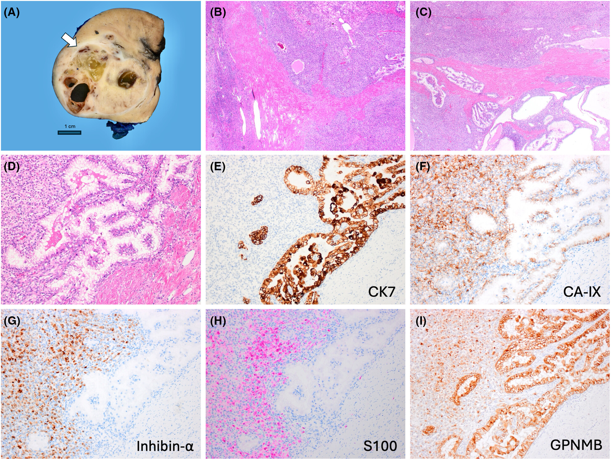 Renal cell carcinoma with fibromyomatous stroma (RCC FMS) and with hemangioblastoma-like areas is part of the RCC FMS spectrum in patients with tuberous sclerosis complex