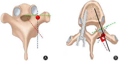 Detection of Common Anatomical Landmarks and Vertical Trajectories for Freehand Pedicle Screw Placement