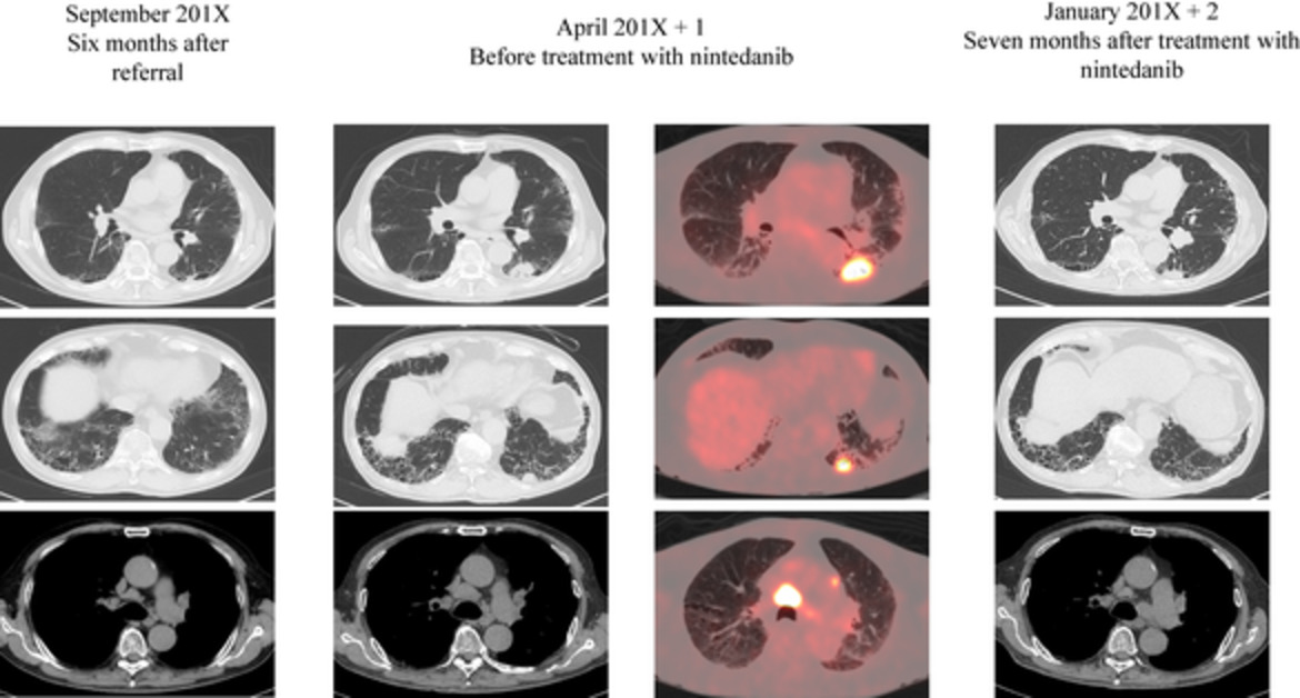 Remarkable response of non-small cell lung cancer to nintedanib treatment in a patient with idiopathic pulmonary fibrosis