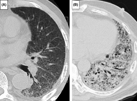 High-dose steroid therapy for acute respiratory distress syndrome lacking common risk factors: predictors of outcome