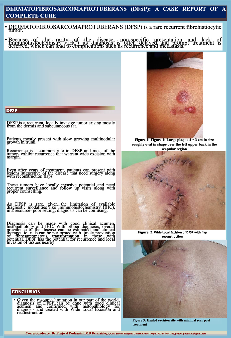 DermatoFibroSarcoma Protuberans: A case report of a complete cure