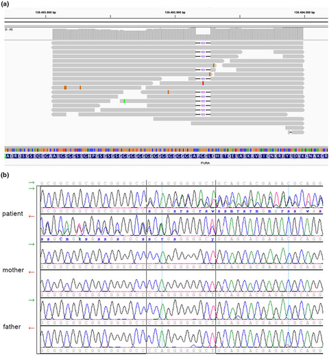 Novel frameshift mutation in PURA gene causes severe encephalopathy of unclear cause