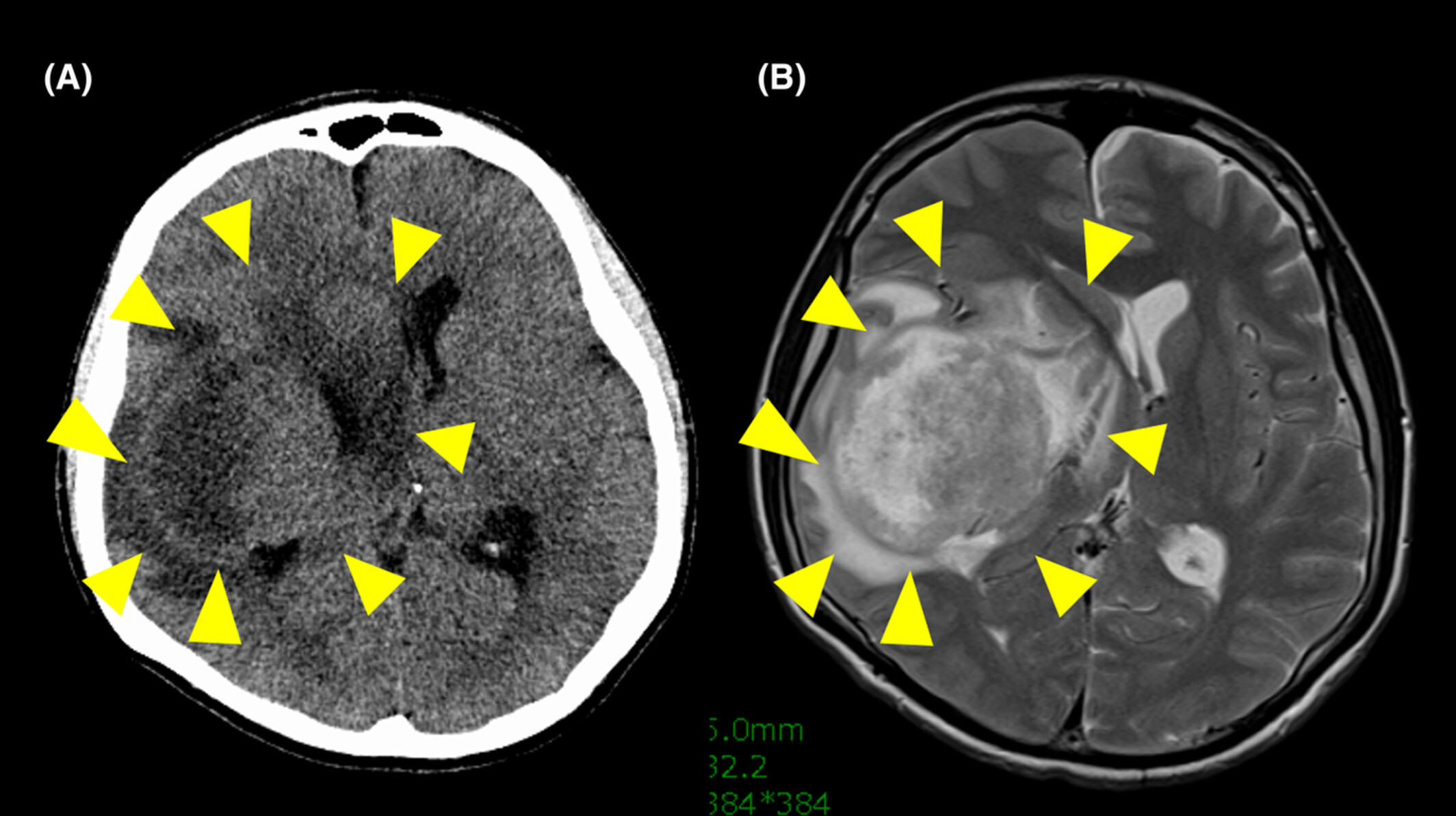 A retrospective analysis of the prognosis of Japanese patients with sarcoma brain metastasis