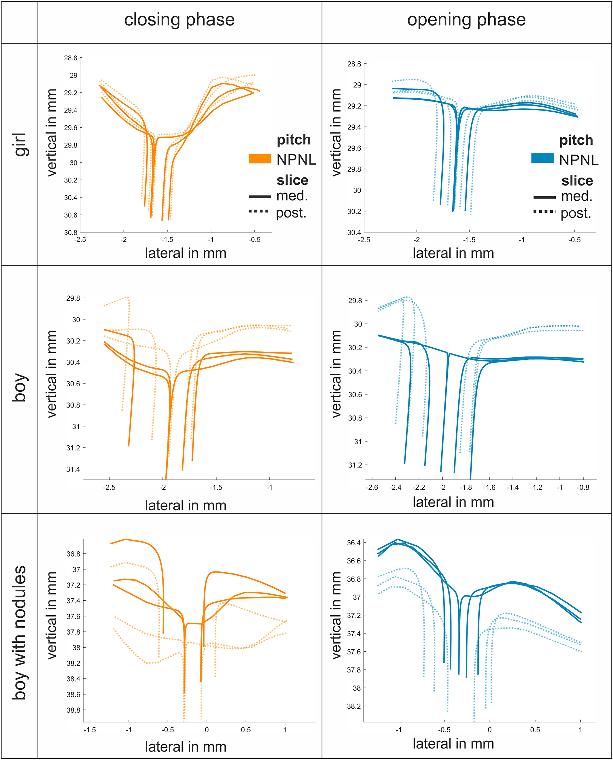 3D reconstruction of vocal fold dynamics with laser high-speed videoendoscopy in children