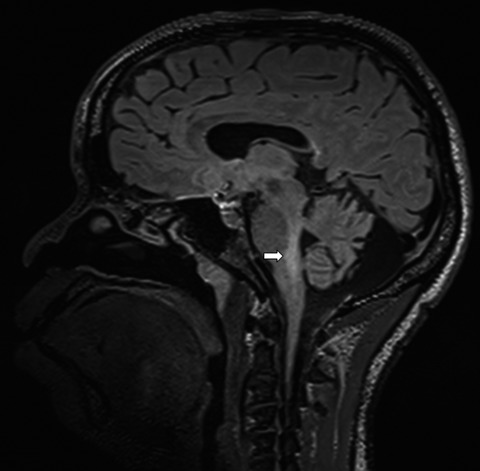 Brainstem progressive multifocal leukoencephalopathy