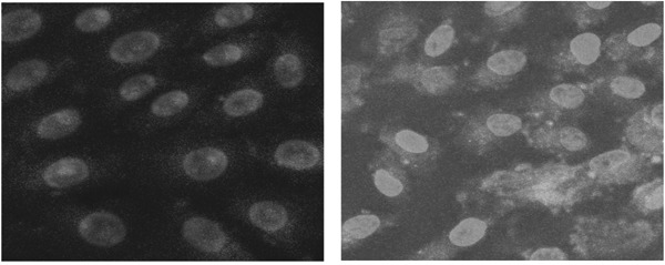 Promotion on Nucleation and Aggregation of Calcium Oxalate Crystals by Injured African Green Monkey Renal Epithelial Cells