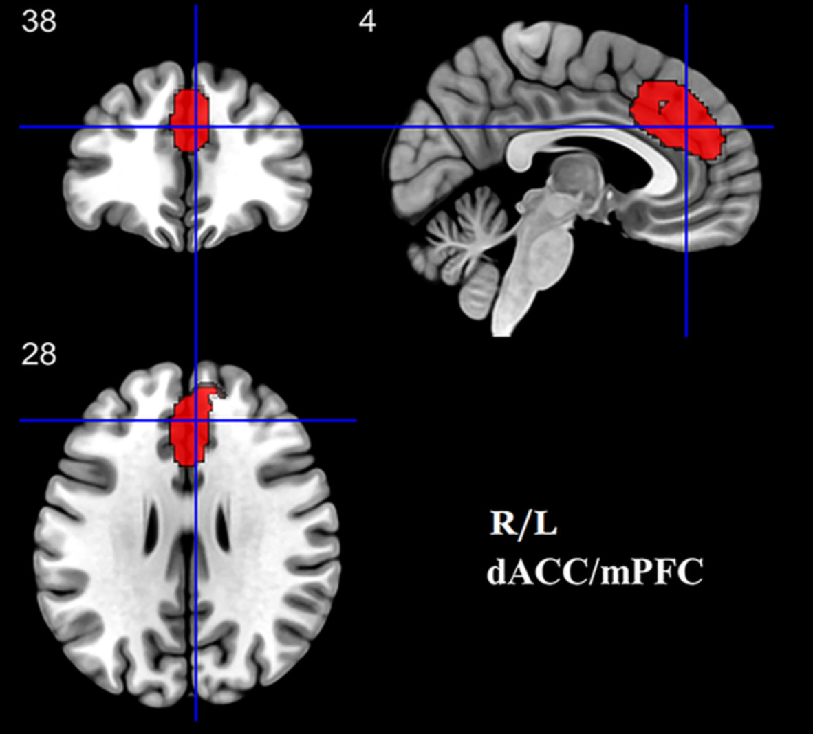Gray matter structures associated with neuroticism: A meta-analysis of whole-brain voxel-based morphometry studies