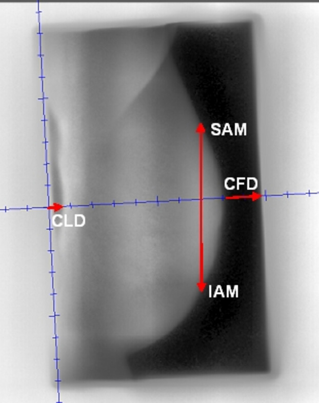 Quantifying intra- and inter-fractional motion in breast radiotherapy