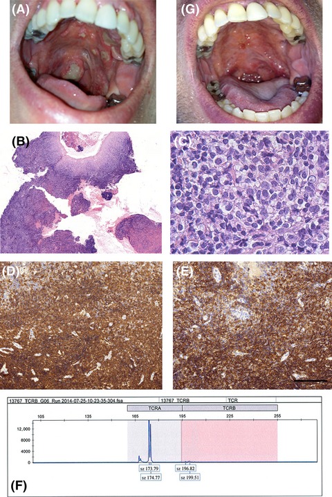 Mature CD8+ T-cell clonal expansion in the oral cavity and digestive tract: a severe lymphoid malignancy that mimics Crohn's disease