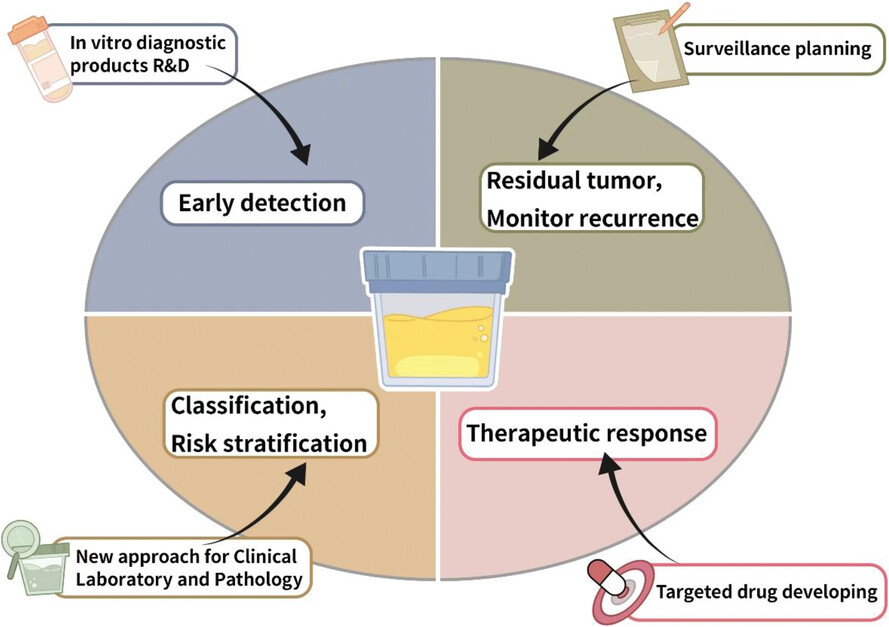 Urine-based liquid biopsy in bladder cancer: Opportunities and challenges
