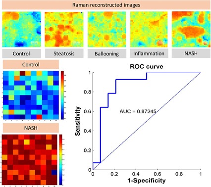 Development of a classification model for non-alcoholic steatohepatitis (NASH) using confocal Raman micro-spectroscopy