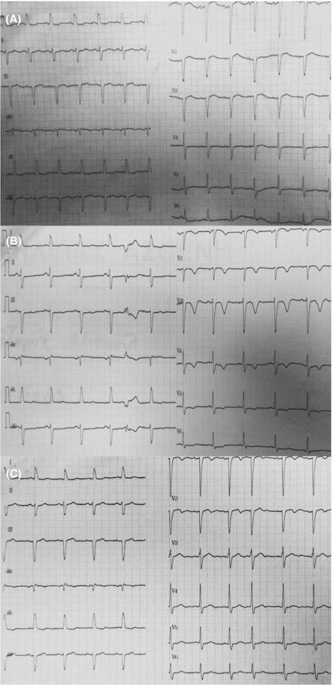 Late T-wave inversion following resolution of non-ischemic acute pulmonary edema