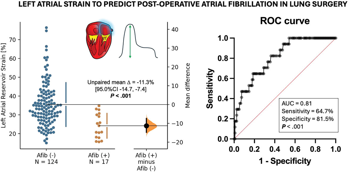 Pre-Operative Atrial Deformation Indices Predict Post-Operative Atrial Fibrillation in Patients Undergoing Lung Resection Surgery